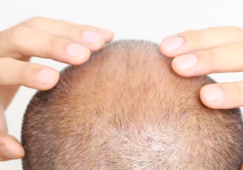 Common Hair Concerns in Men: An In-Depth Look